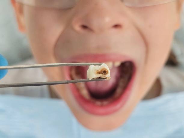 Best Emergency Tooth Extraction in Frontenac, MO